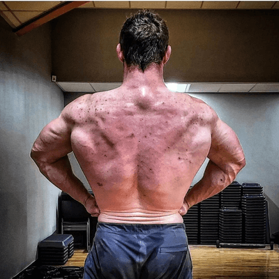 Steroid Acne Steroid Acne